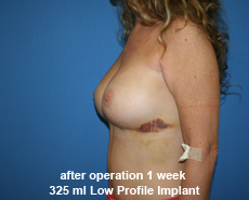 plastic-surgery-breast-augmentation